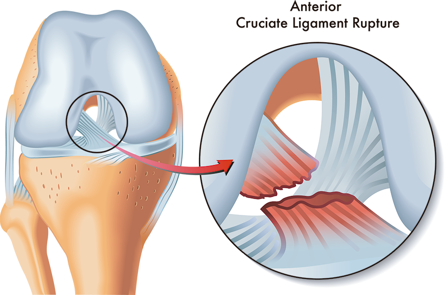 Reparacion de LCA rodilla cdmx Reparacion de LCA rodilla cdmx
